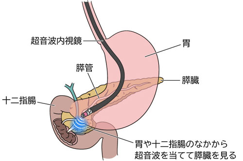 EUSでは、内視鏡の先端から超音波を出し、胃や十二指腸の壁越しに膵臓を観察する(『命を守る「すい臓がん」の新常識』より)