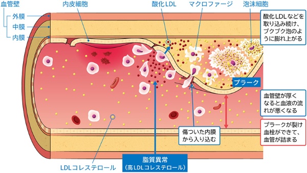 高コレステロールの人は要注意 血管のコブは薬を飲んでも消えない | 日経BOOKプラス